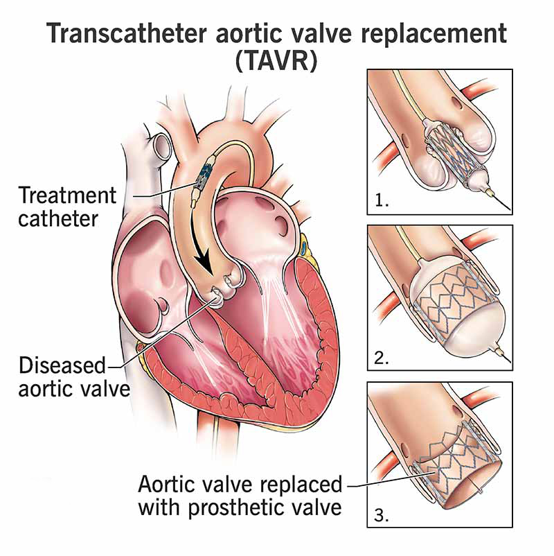 TAVR-transcatheter-aortic