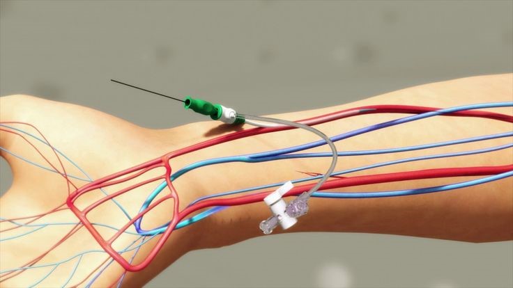 Transradial intervention